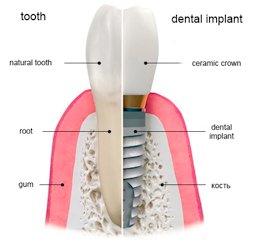 Зубні імплантати виробник
