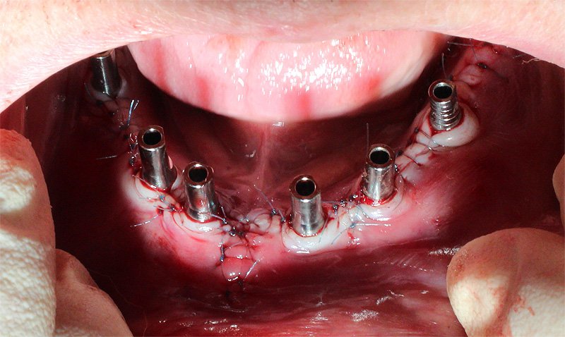 Установка 2 коротких имплантатов в области зубов 36, 46