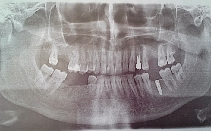 Установлка имплантата в области отсутствующего зуба