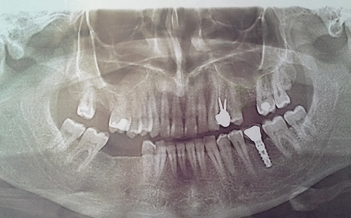 постоянная м/к коронка на имплантат в области зуба 36