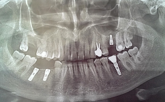 імплантати в області зубів
